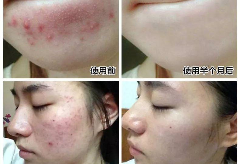 如何有效去除痘痘，全面解析最佳方法，全面解析，如何有效去除痘痘的最佳方法