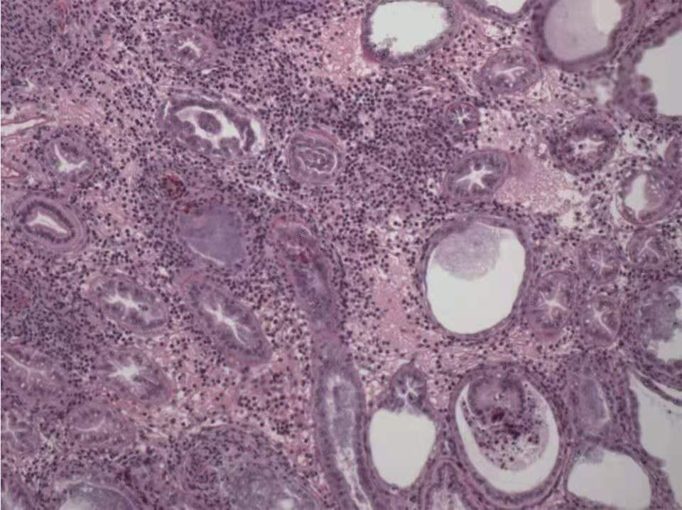 感染艾滋病的第一癥狀，了解、預(yù)防與應(yīng)對(duì)，感染艾滋病的第一癥狀，了解、預(yù)防與應(yīng)對(duì)策略