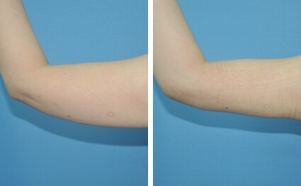 手臂抽脂價(jià)格一覽表——打造纖細(xì)玉臂的必備指南，手臂抽脂價(jià)格詳解，打造纖細(xì)玉臂的必備指南