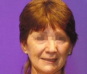 面癱的自我治療方法，面癱自我康復(fù)法，實(shí)用有效的自我治療方法