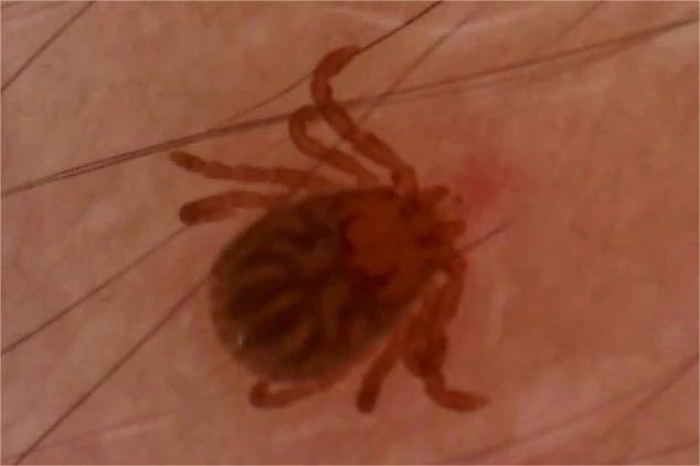 蜱蟲咬人后的癥狀及應(yīng)對(duì)措施，蜱蟲咬人后的癥狀與應(yīng)對(duì)措施解析