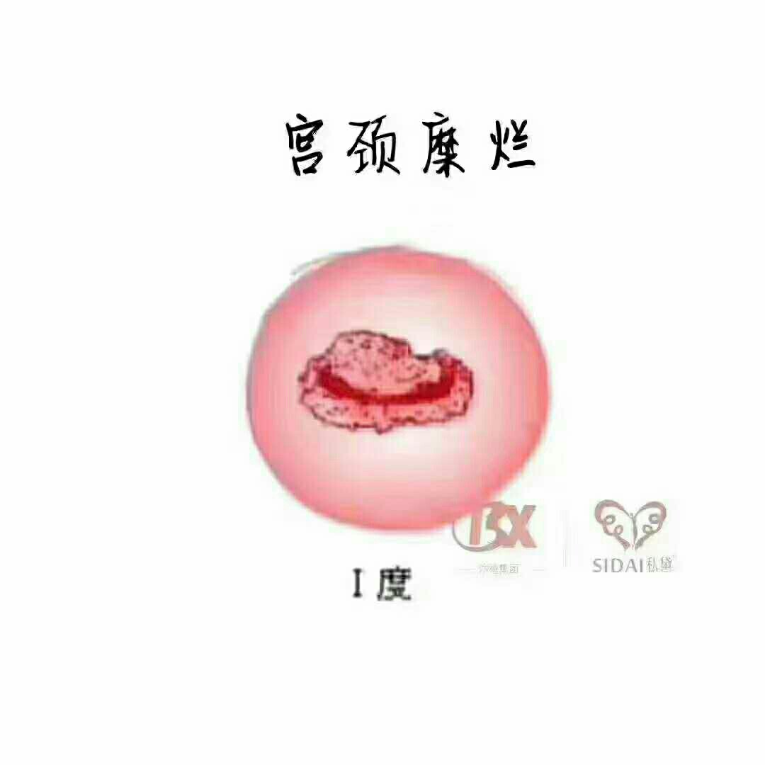 宮頸糜爛會自己恢復(fù)嗎？解讀宮頸健康與自我修復(fù)能力，宮頸糜爛的自我修復(fù)能力與宮頸健康解讀