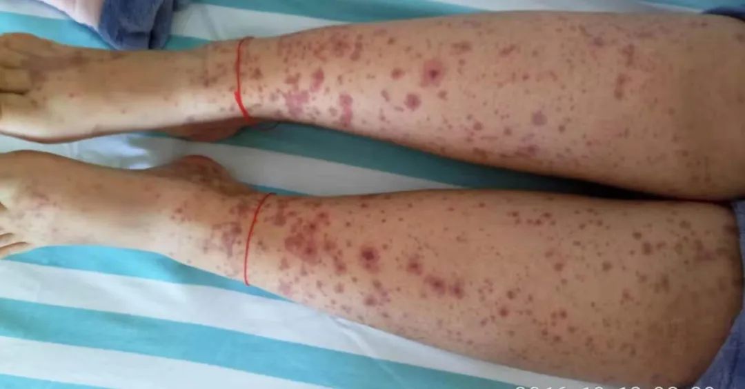 過敏性紫癜是終身病嗎？解析與理解，過敏性紫癜解析，是否為終身疾??？