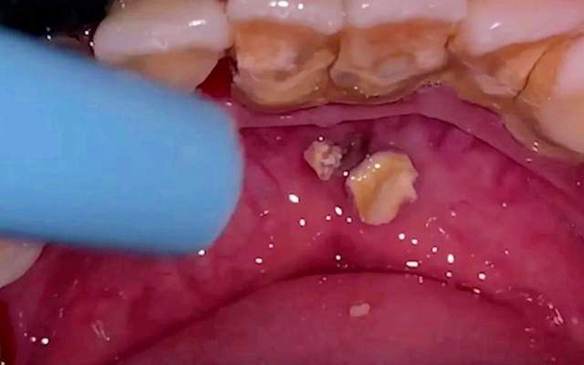 告別牙結(jié)石煩惱，5秒脫落牙結(jié)石的秘密與真相，揭秘，告別牙結(jié)石煩惱，只需5秒輕松脫落的秘密與真相！