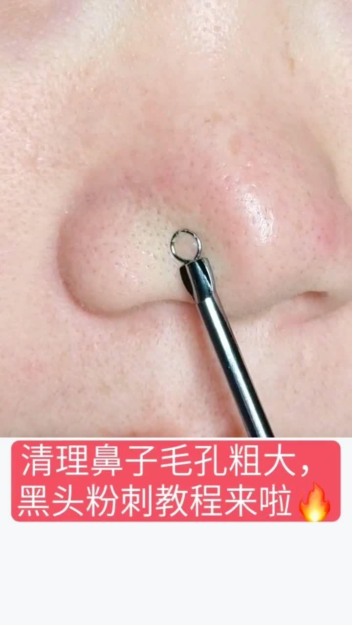 去黑頭小妙招，輕松告別黑頭煩惱，告別黑頭煩惱！實(shí)用去黑頭小妙招分享