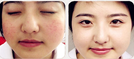 臉上紅血絲的治療方法，全面解析與應(yīng)對之道，全面解析與應(yīng)對之道，臉上紅血絲的治療方法