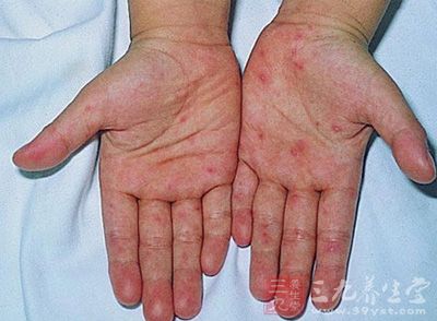 輕微手足口病癥狀圖片解析，輕微手足口病癥狀圖片解析及解析報(bào)告