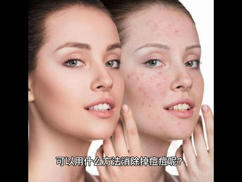 簡(jiǎn)單有效的去臉上痘痘方法，簡(jiǎn)單有效的臉部祛痘方法分享