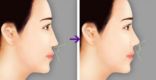 鼻子整容費(fèi)用咨詢，全面了解鼻子整形手術(shù)費(fèi)用及影響因素，鼻子整容費(fèi)用全面解析，手術(shù)費(fèi)用及影響因素深入了解