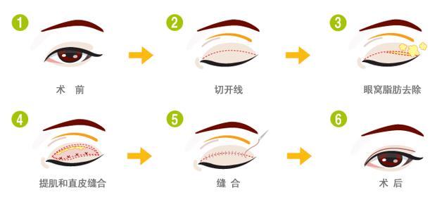 成都雙眼皮手術(shù)，尋找最優(yōu)秀的醫(yī)療機(jī)構(gòu)，成都雙眼皮手術(shù)最佳醫(yī)療機(jī)構(gòu)尋找指南