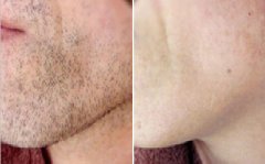 臉部脫毛需要多少錢(qián)，全面解析費(fèi)用因素與選擇建議，臉部脫毛費(fèi)用詳解，全面解析費(fèi)用因素與選擇建議