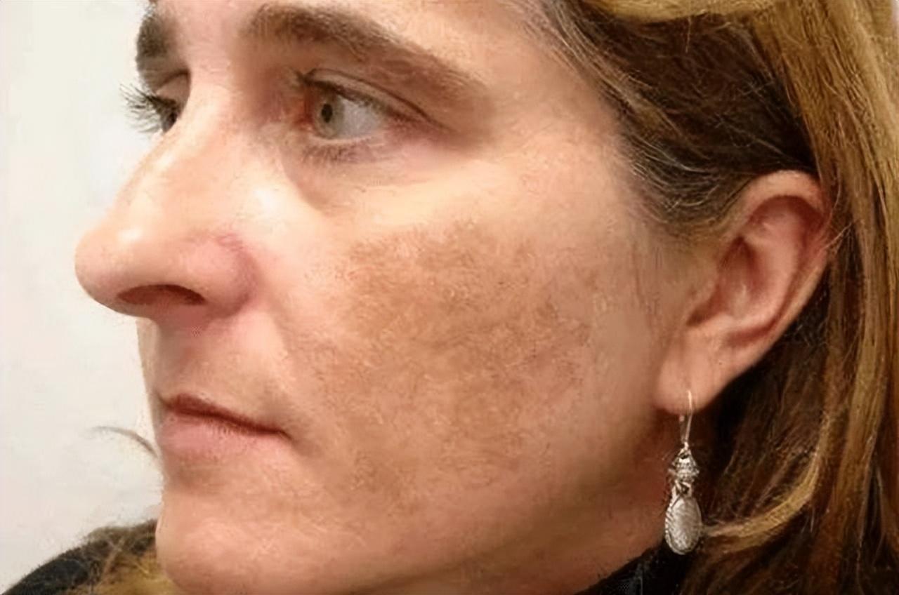 如何有效去除老年斑——全方位指南，全方位指南，如何有效去除老年斑