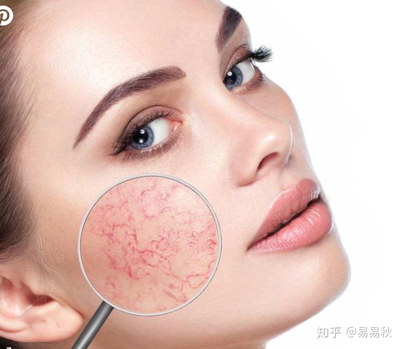 紅血絲的最佳改善方法，紅血絲的最佳改善方法總結(jié)與分享