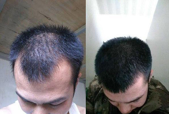 男生脫發(fā)嚴(yán)重怎么改善，男生脫發(fā)嚴(yán)重如何改善？有效方法大揭秘