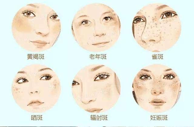 黃褐斑早期圖片，識(shí)別、預(yù)防與應(yīng)對(duì)，黃褐斑早期識(shí)別、預(yù)防與應(yīng)對(duì)策略及圖片解析