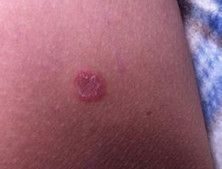 硬下疳，深入了解與應(yīng)對(duì)之道，硬下疳，全面解析與應(yīng)對(duì)策略