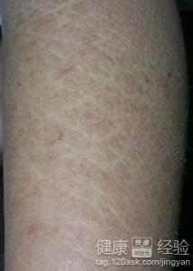 魚鱗皮膚病如何才能根治，全面解析與應(yīng)對(duì)策略，全面解析魚鱗皮膚病根治之道，應(yīng)對(duì)策略大揭秘