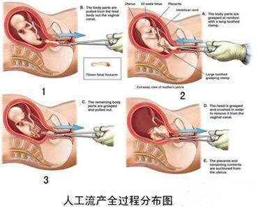 人流半個(gè)月后是否可以帶套進(jìn)行性行為？解析與注意事項(xiàng)，人流半個(gè)月后帶套性行為解析及注意事項(xiàng)