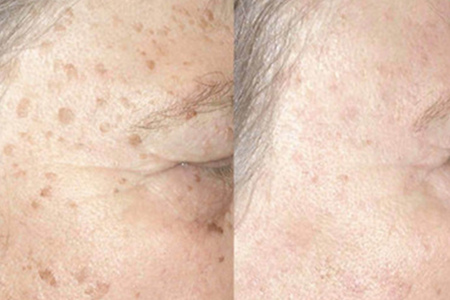 怎樣消除老年斑——全面解析與應(yīng)對策略，全面解析，消除老年斑的應(yīng)對策略