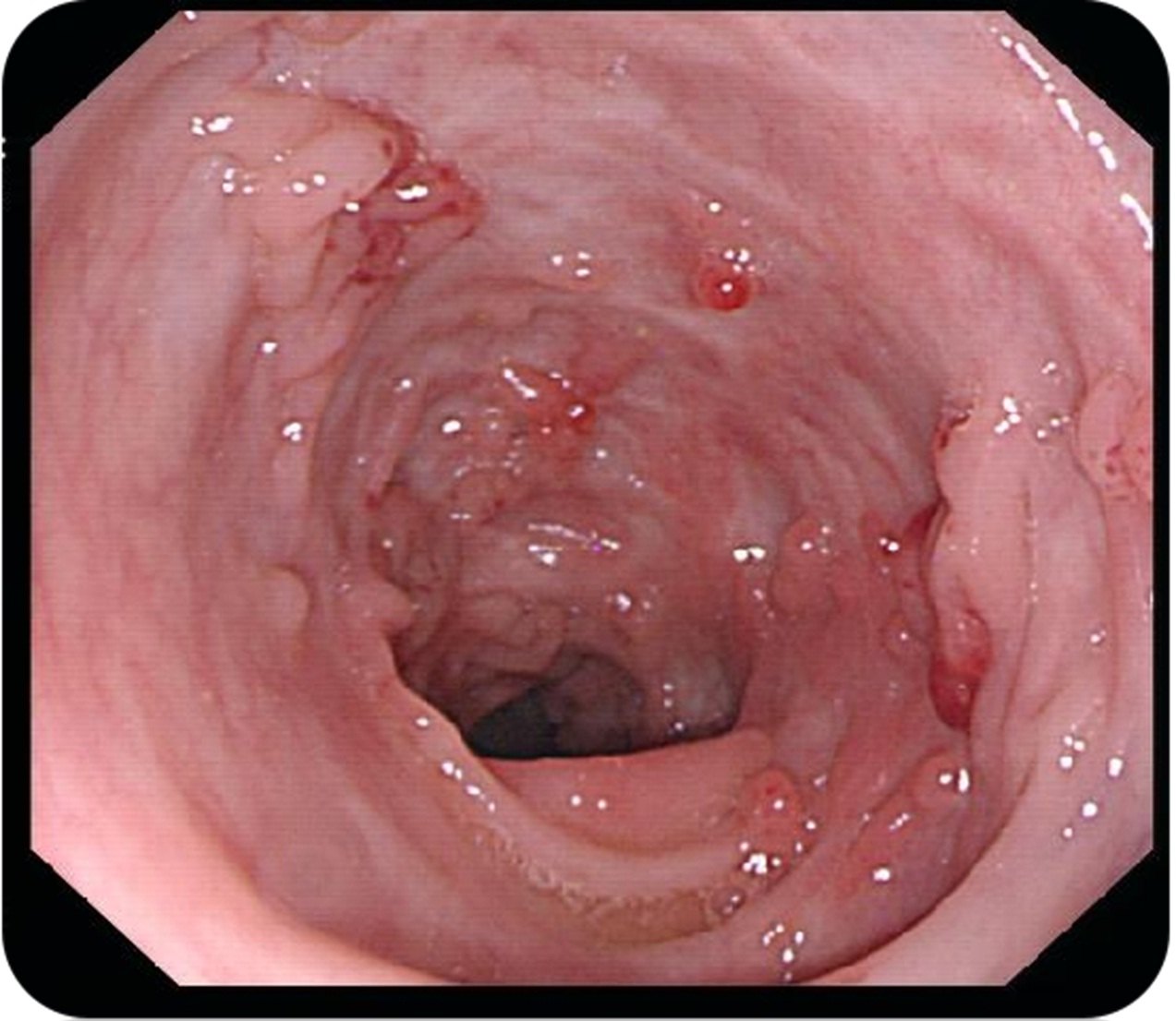 克羅恩病最常見的癥狀是什么？一篇文章深度解析，深度解析，克羅恩病最常見癥狀解析