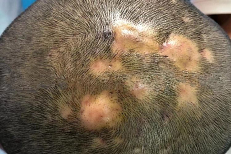 毛囊炎硬疙瘩圖片，了解、識(shí)別與治療，毛囊炎硬疙瘩詳解，識(shí)別圖片、了解與治療