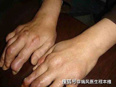 類風(fēng)濕手指疼痛首發(fā)部位解析，哪個(gè)手指會(huì)先疼？，類風(fēng)濕手指疼痛解析，首發(fā)部位及預(yù)測(cè)哪個(gè)手指先疼？