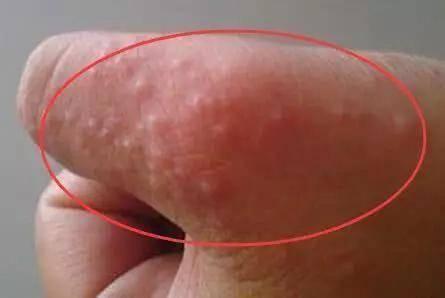 生殖上長(zhǎng)小水泡的原因，深度解析與應(yīng)對(duì)建議，生殖部位小水泡成因深度解析及應(yīng)對(duì)建議