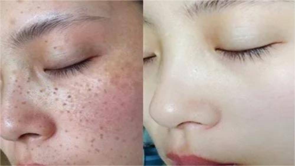 哪種祛斑方法最有效不反彈，全面解析最有效的祛斑途徑，全面解析，最有效的祛斑方法，不反彈之選！