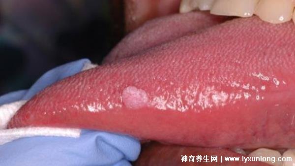 關于HPV感染舌頭初期的圖片及其相關解析，HPV感染舌頭初期癥狀圖片與解析