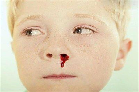 兒童白血病流鼻血的特點及其重要性，兒童白血病流鼻血特征與重要性解析