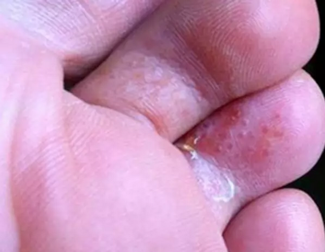 濕疹和腳氣區(qū)別圖，深入了解兩種常見(jiàn)皮膚狀況，濕疹與腳氣區(qū)別詳解，直觀圖表解析兩種常見(jiàn)皮膚狀況
