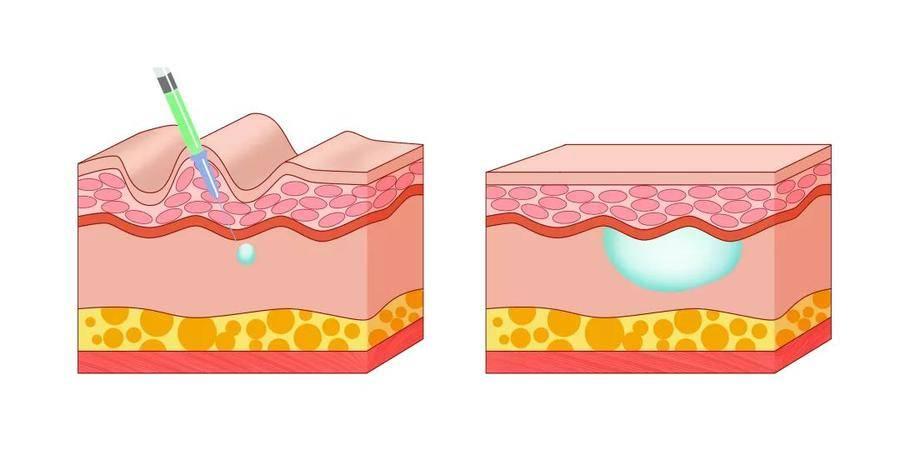 法令紋去除最安全永久的方法，全面解析與實(shí)用建議，全面解析法令紋永久安全去除法，實(shí)用建議與最佳實(shí)踐
