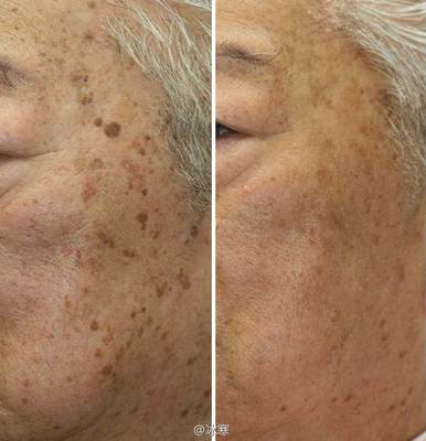 如何有效去除老年斑——全面解析，全面解析，有效去除老年斑的方法