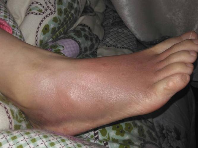 腳腫是什么原因引起的，深度解析腳部腫脹的多元因素，腳部腫脹的深度解析，多元因素引起的腳腫原因探究