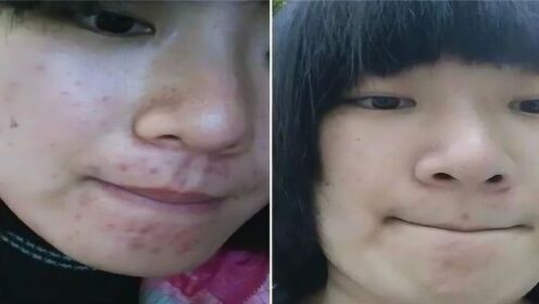 揭秘三天快速去痘印小竅門，輕松恢復肌膚光彩，三天快速去痘印秘訣大揭秘，輕松重塑肌膚光彩