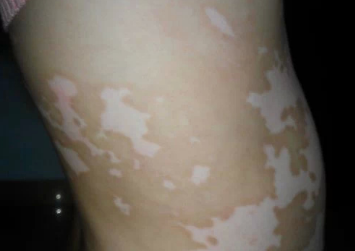 白顛瘋病初期照片癥狀圖片，了解白癜風(fēng)早期表現(xiàn)與防治，白癜風(fēng)初期癥狀圖片解析，了解白癜風(fēng)早期表現(xiàn)與防治攻略