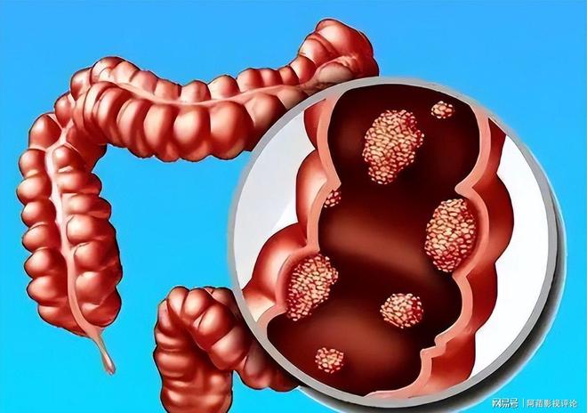 大便形態(tài)變化，細(xì)探腸癌征兆，大便形態(tài)變化揭示腸癌征兆