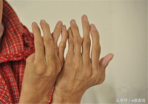 風(fēng)濕性關(guān)節(jié)炎的最佳治療方案，風(fēng)濕性關(guān)節(jié)炎的最佳治療策略或方案