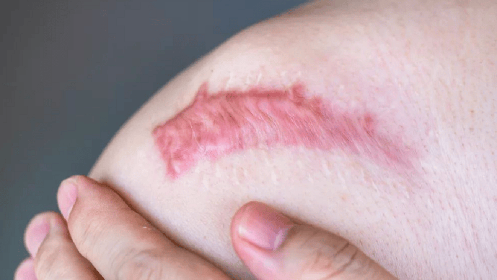 疤痕增生，成因、治療與預(yù)防，疤痕增生，成因、治療方法及預(yù)防措施