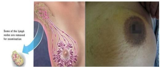 如何排除乳腺癌，自我預(yù)防與早期發(fā)現(xiàn)的重要性，如何預(yù)防與早期發(fā)現(xiàn)乳腺癌，自我檢查與重要性解析