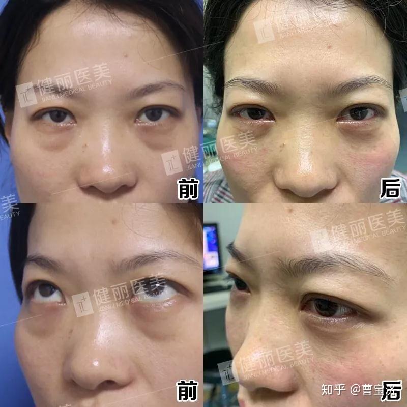 如何有效去除黑眼圈與眼袋，重塑明亮雙眼，如何消除黑眼圈與眼袋，重塑明亮雙眸的秘訣