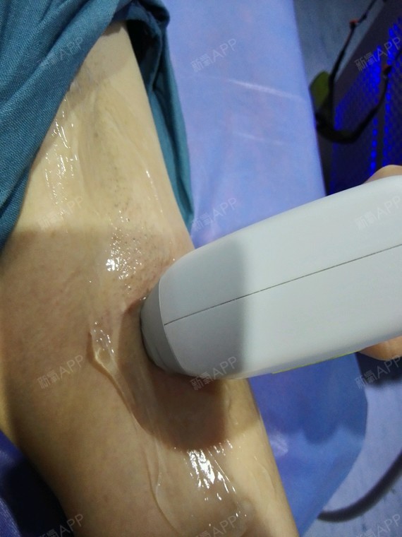 激光脫毛，疼痛感受與體驗(yàn)解析，激光脫毛，疼痛感受與體驗(yàn)詳解