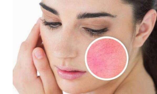 如何有效去除紅血絲，最佳方法與實(shí)用建議，紅血絲去除攻略，最佳方法與實(shí)用建議