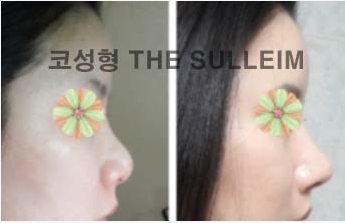 如何縮小鼻翼不手術(shù)，實用方法與建議，不手術(shù)縮小鼻翼的實用方法與建議