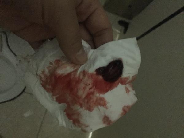 自然流產(chǎn)后的清宮問題解析——自己流掉了需要清宮嗎？，自然流產(chǎn)后需清宮嗎？——深度解析清宮問題疑慮！