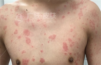 晚上發(fā)作的蕁麻疹名稱(chēng)及其相關(guān)知識(shí)解析，夜間蕁麻疹發(fā)作解析，癥狀、原因與知識(shí)科普