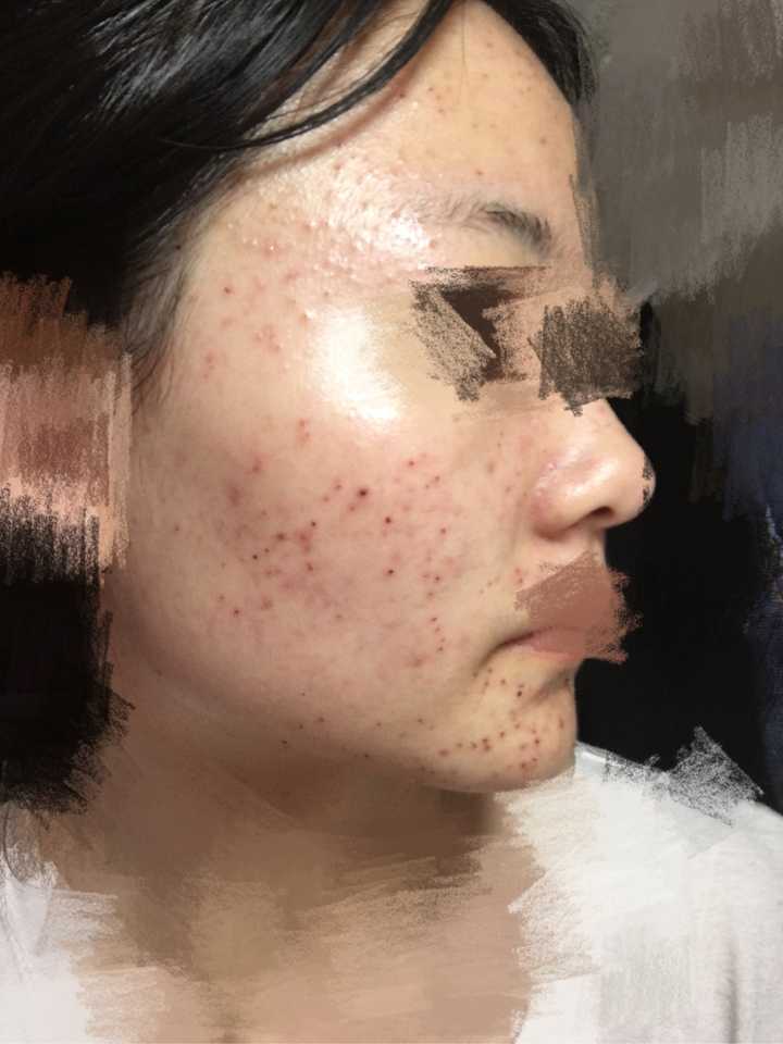 激光祛痘痘有效果嗎，深度解析與全面理解，激光祛痘效果深度解析與全面理解指南