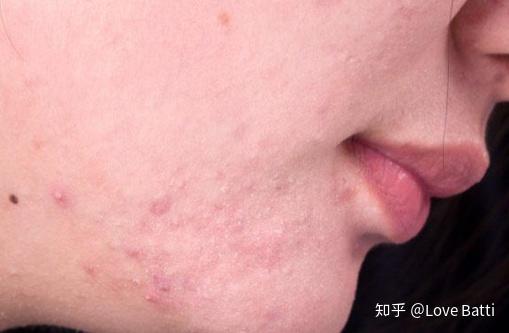 如何判斷臉上是否有螨蟲，全面解析與應對建議，全面解析，如何判斷臉上是否有螨蟲及應對建議