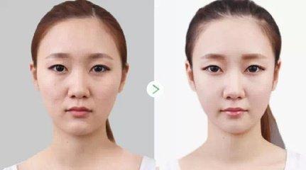 關(guān)于美白針多久打一次的全面解析，美白針注射頻率全面解析，多久打一次？