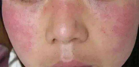 臉過敏發(fā)紅癢怎么辦——臉部過敏急救指南，臉部過敏發(fā)紅癢怎么辦？急救指南助你快速緩解不適！